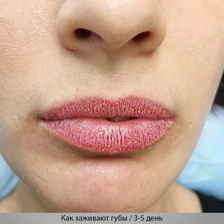 Gojenie ust po makijażu permanentnym - pełny proces i porady